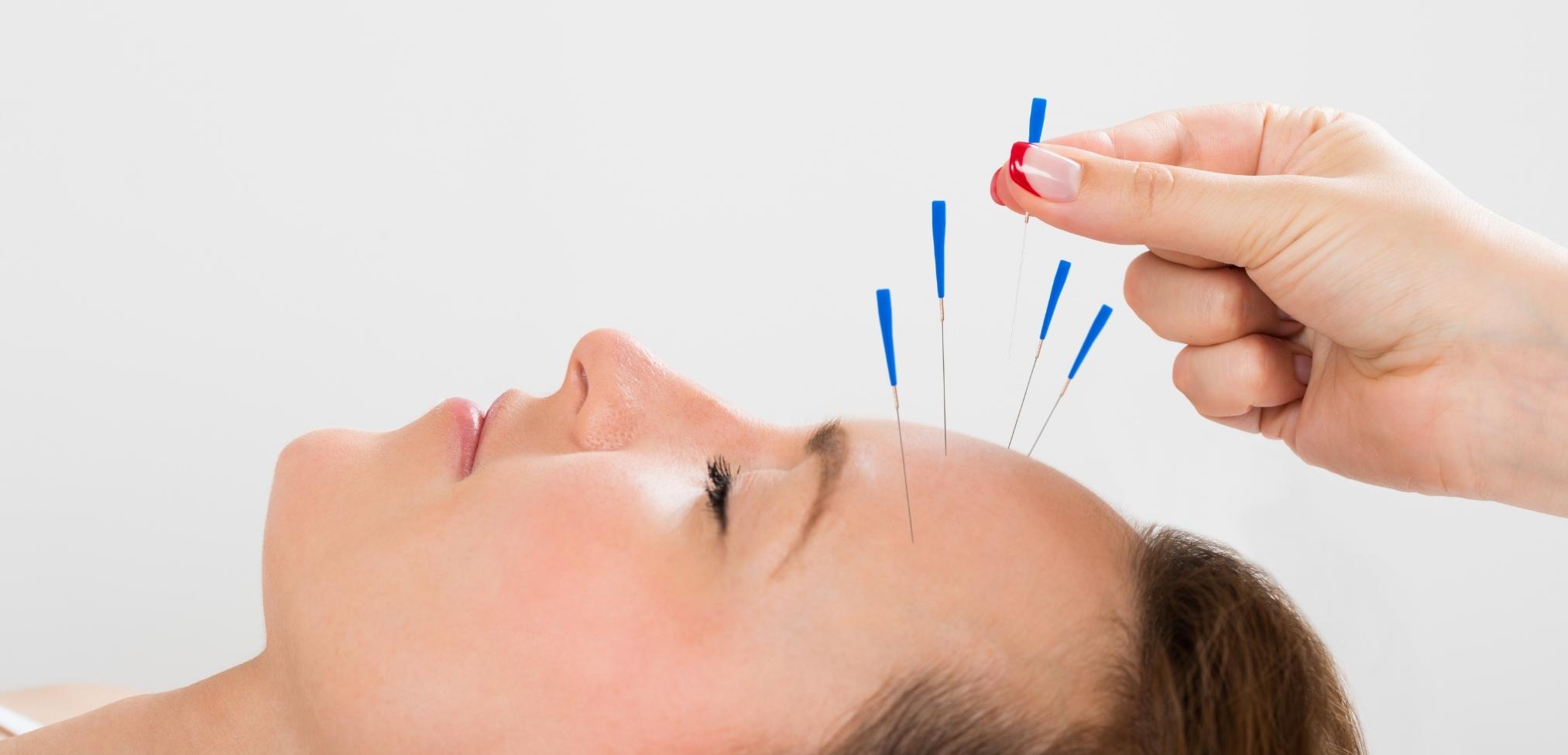 Acupuntura